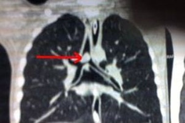 Bé 3 tuổi nguy kịch vì hạt đậu phộng lọt vào phổi