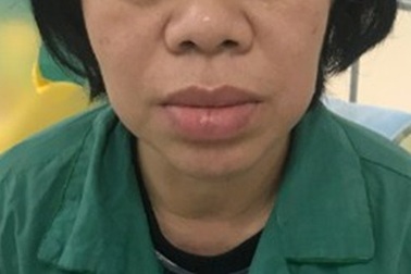 Tưởng "phát tướng" vì tay chân to, mũi nở, không ngờ bệnh nguy hiểm