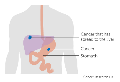 Dấu hiệu bệnh ung thư đã di căn - 1