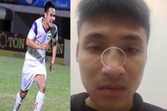 Thực hư chuyện cầu thủ SL Nghệ An đánh gãy mũi đối thủ