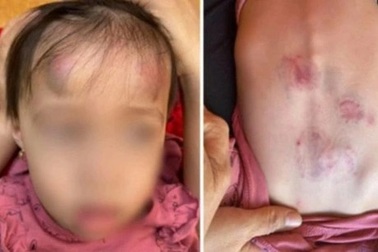 Tạm đình chỉ cơ sở mầm non để trẻ đánh, cắn bạn bầm tím người