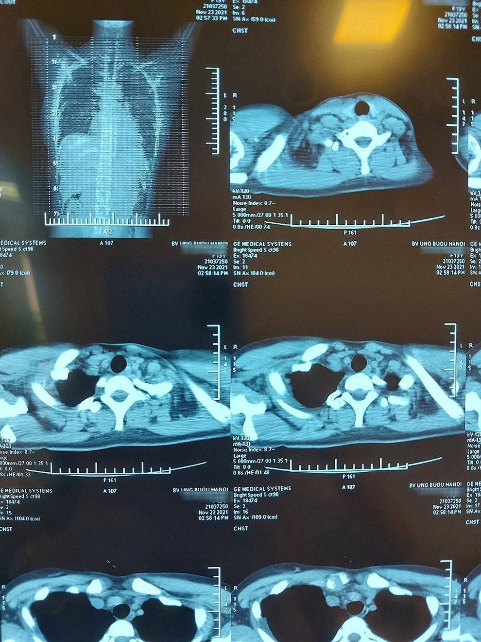 Cô gái 19 tuổi ở Hà Nội bị khối u quái to 20cm đè bẹp phổi - 1 Cô gái 19 tuổi ở Hà Nội bị khối u quái to 20cm đè bẹp phổi - 1
