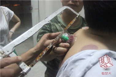 Giác hơi xong, cầu cứu… lính cứu hỏa