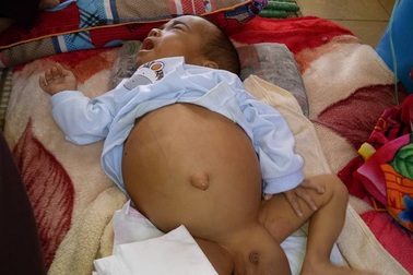 Nhói lòng bé 10 tháng tuổi bị teo mật bẩm sinh