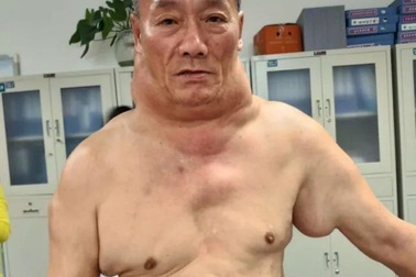 Sưng cổ nghiêm trọng vì uống rượu mạnh "như nước lã"