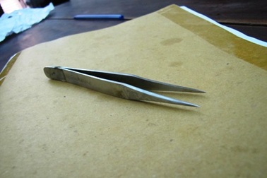 Phẫu thuật lấy kẹp sắt dài 12cm trong bụng