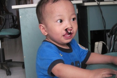 Bé Nhân Nghĩa sắp bước vào ca phẫu thuật lần hai