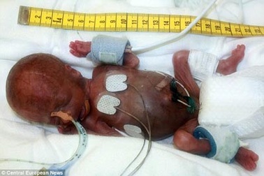 Nuôi dưỡng thành công em bé chào đời lúc 25 tuần tuổi