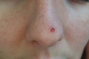 Làm đẹp không phòng bị cẩn thận, cô gái phải cắt bỏ một phần mũi