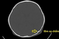 Cậu bé 2 tuổi bị lõm hộp sọ vì tai nạn nguy hiểm thường gặp