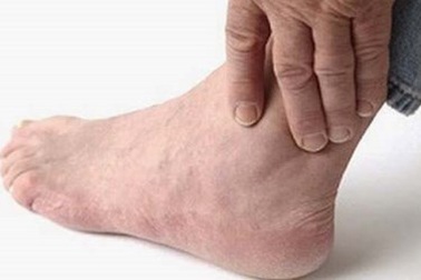 Có cách nào để chữa vẩy nến?