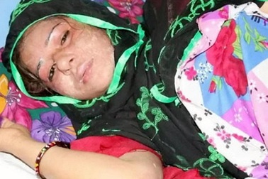 Dã man chồng đổ axit vào mặt vợ trong lúc ngủ