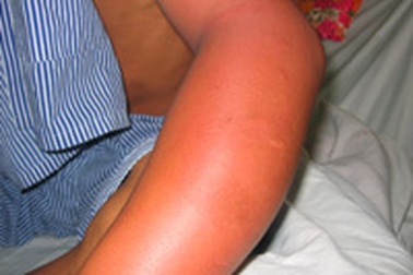 Tự tiêm thuốc sâu vào người để tự tử 