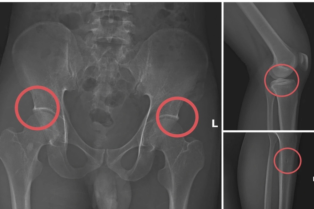 Giải đáp pháp lý vụ tự đục vỡ xương khớp để trục lợi bảo hiểm - 3