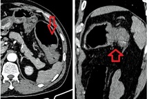 Cảnh báo ung thư đại tràng từ những dấu hiệu tưởng thông thường
