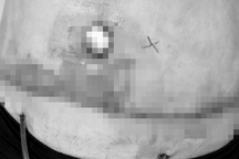 TPHCM: Người phụ nữ biến dạng bụng nặng nề sau khi bỏ 80 triệu đồng hút mỡ