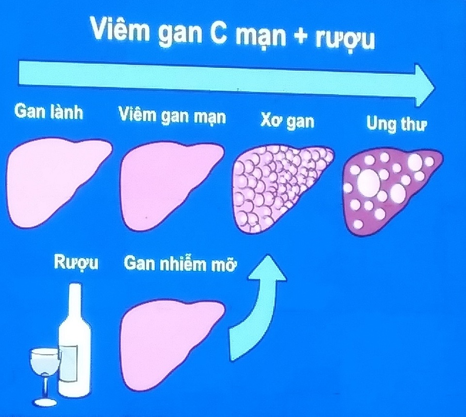 Ung thư gan đang hủy diệt sự sống của người Việt Nam - 3 Ung thư gan đang hủy diệt sự sống của người Việt Nam - 3