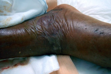 Kon Tum: Xuất hiện vi khuẩn ăn thịt người?