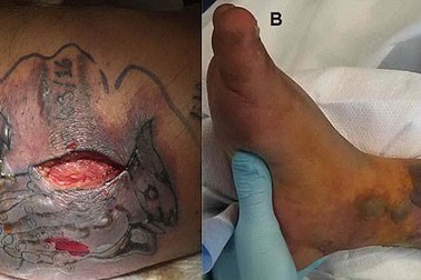 Tử vong do đi bơi sau khi xăm mình