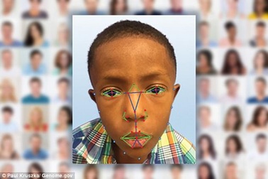 Chẩn đoán bệnh hiếm qua ảnh “tự sướng”