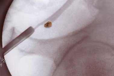 “Giải phẫu” bệnh sỏi thận