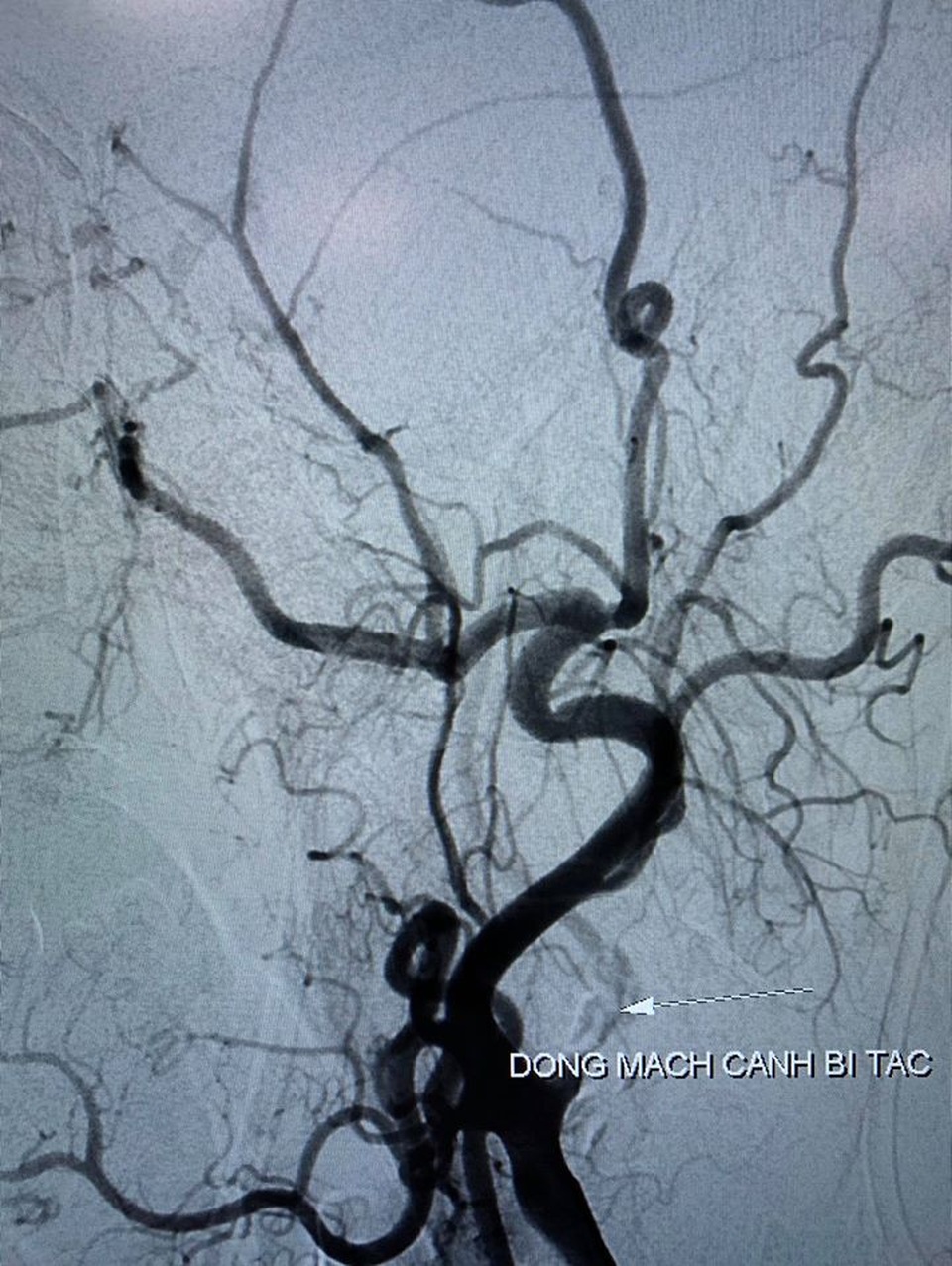 Hiểu lầm “thời gian vàng” can thiệp đột quỵ bệnh nhân sẽ mất mạng - 1