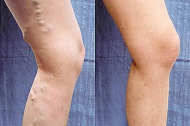 Mạch máu biến dạng vì đứng 8-12 tiếng mỗi ngày