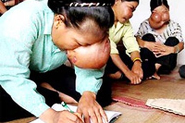 5 chị em bị biến dạng mặt vì bệnh lạ