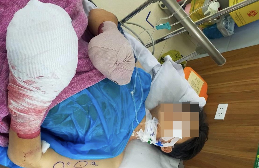 Sau tiếng nổ lớn, cháu bé 14 tuổi nát bàn tay - 1 Sau tiếng nổ lớn, cháu bé 14 tuổi nát bàn tay - 1