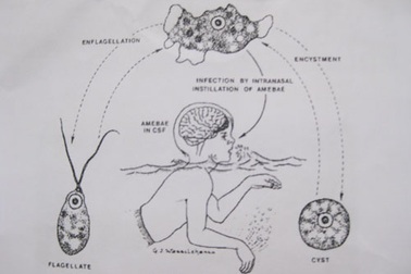 Một bệnh nhân tử vong vì amip “ăn não”