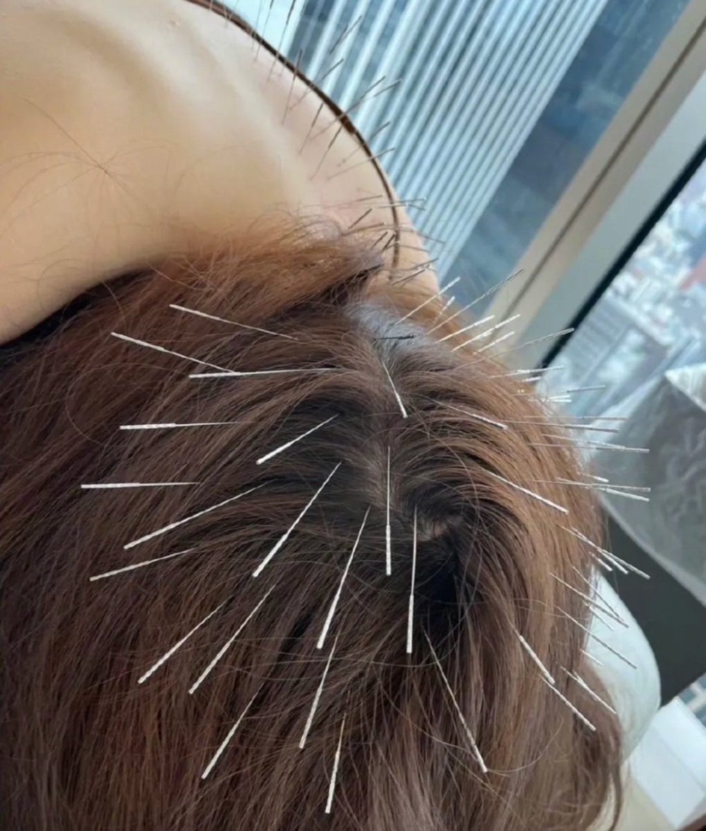 Rộ mốt châm kim đầy mặt giết suy nghĩ tiêu cực, 30 phút tốn 34 triệu đồng - 2 Rộ mốt châm kim đầy mặt giết suy nghĩ tiêu cực, 30 phút tốn 34 triệu đồng - 2