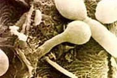 Bệnh huyết trắng và cách xử lý