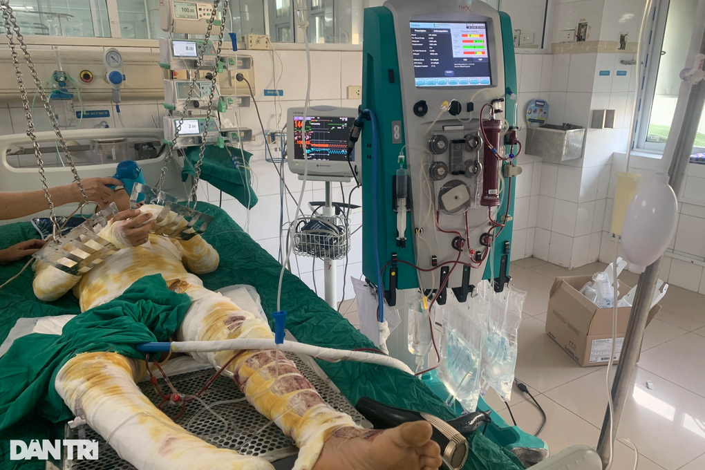 Chàng trai trẻ bốc cháy như ngọn đuốc, bỏng 71% cơ thể - 4 Chàng trai trẻ bốc cháy như ngọn đuốc, bỏng 71% cơ thể - 4