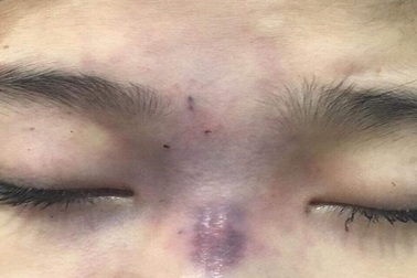 Chồng tiêm filler làm mù mắt vợ