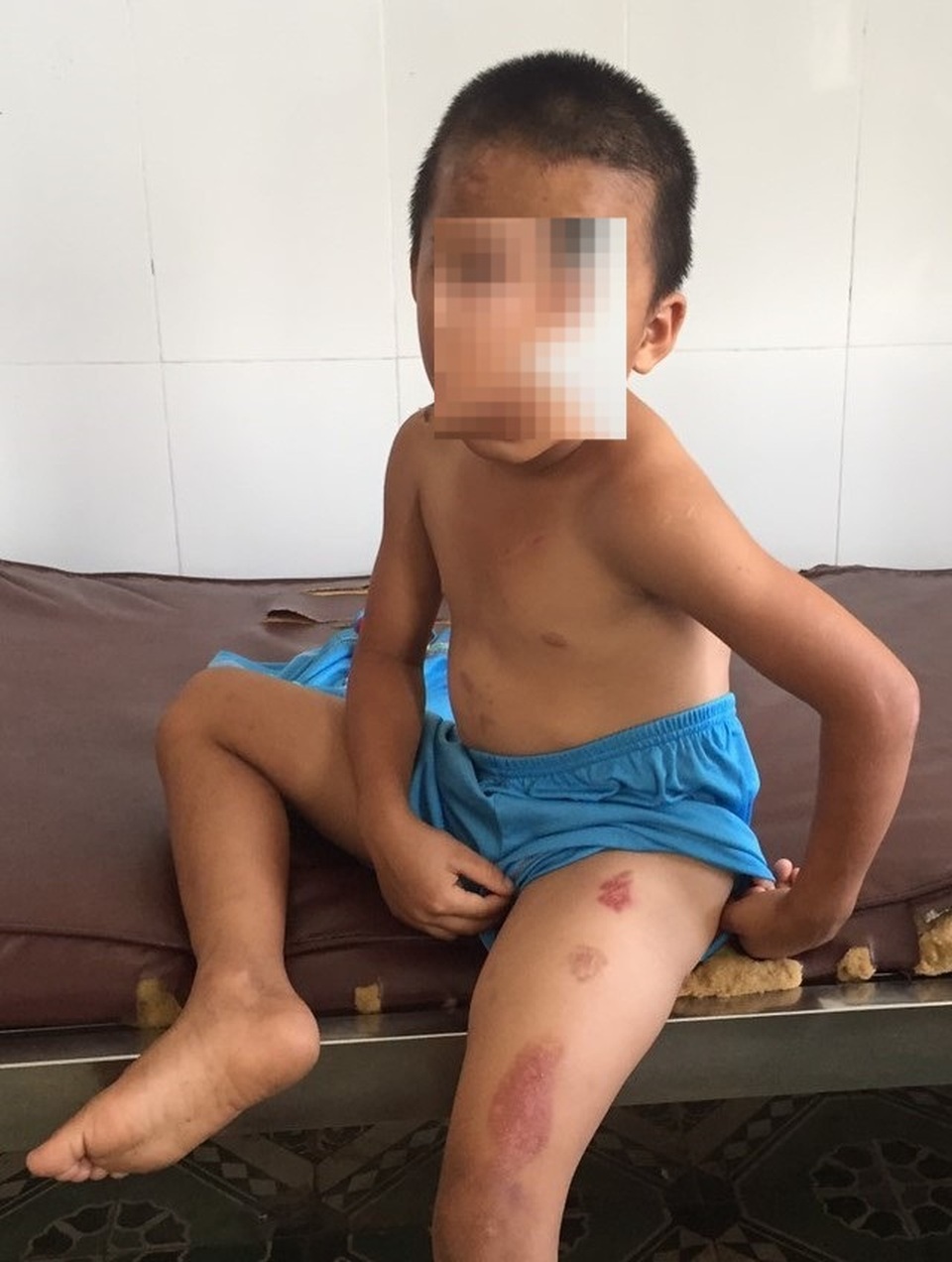 Vụ bé trai bị cắt thịt, dí thuốc lá cháy: Khởi tố, tạm giam gã cha dượng - 1 Vụ bé trai bị cắt thịt, dí thuốc lá cháy: Khởi tố, tạm giam gã cha dượng - 1