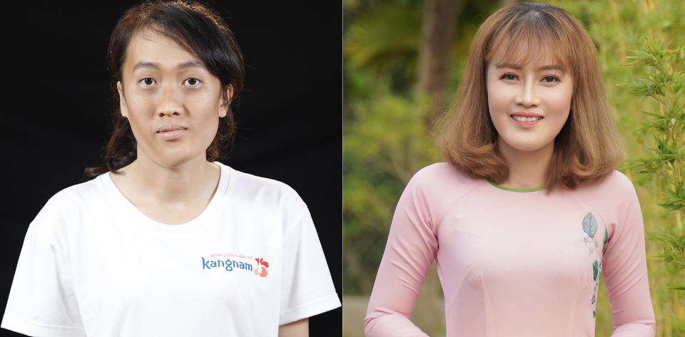 Cần tới 11 tiếng để thực hiện ca phẫu thuật khuôn mặt vặn xoắn hy hữu trong thẩm mỹ - 3