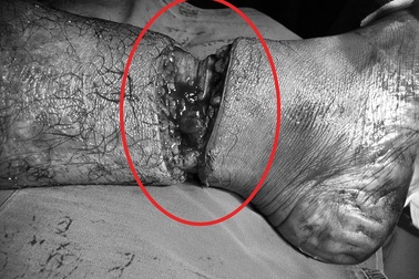 Nam công nhân bị dây cáp cắt gần lìa cẳng chân