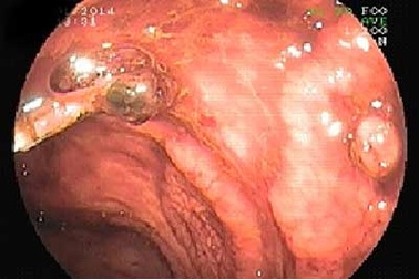 Một bệnh nhân bị chảy máu ruột nặng hiếm gặp