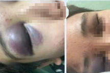 Mâu thuẫn tình cảm, nam sinh lớp 10 bị đánh vỡ xương sọ