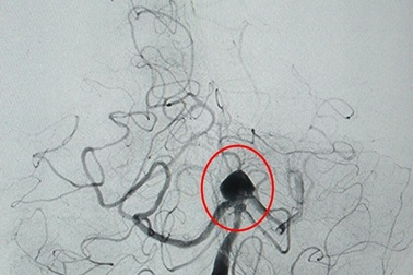 Đau đầu đột ngột, biểu hiện của bệnh lý nguy hiểm