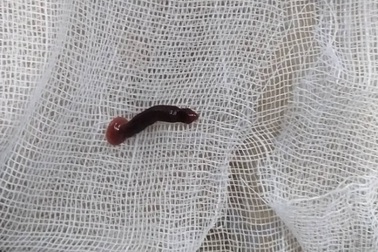 Thiếu nữ 16 tuổi bị chảy máu mũi vì nguyên nhân không ngờ