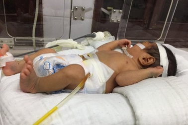 Hy hữu: Bé sơ sinh 2 ngày tuổi bị vỡ dạ dày