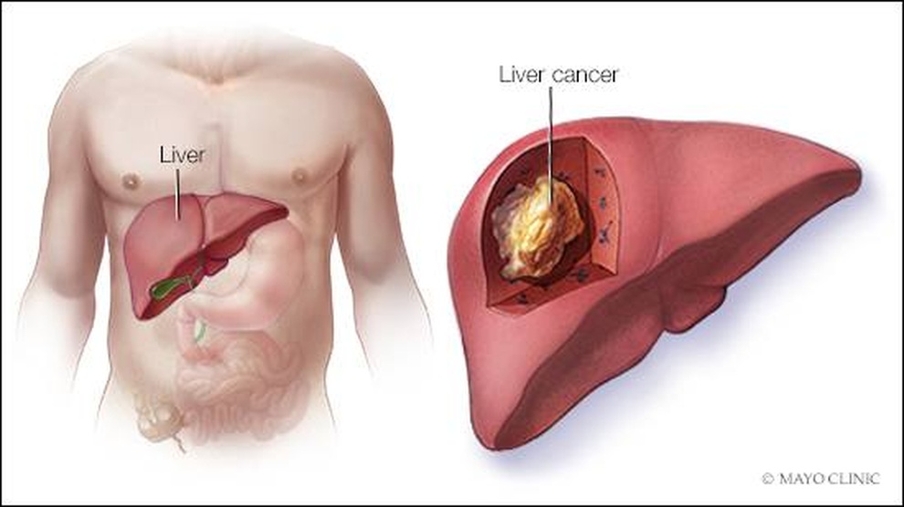 Mối liên hệ giữa viêm gan B và ung thư gan - 1 Mối liên hệ giữa viêm gan B và ung thư gan - 1
