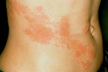 Ớt cay giúp giảm đau do zona?