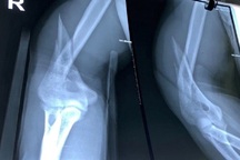 Nam thanh niên bất ngờ gãy gập xương khi vật tay với bạn