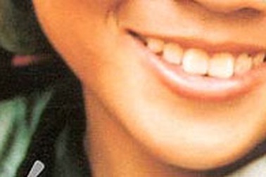 Hỏng răng vì làm trắng cấp tốc