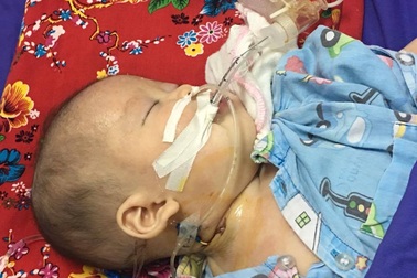 Bé hôn mê, thở máy vì mẹ cho dùng thuốc cam chữa viêm da cơ địa