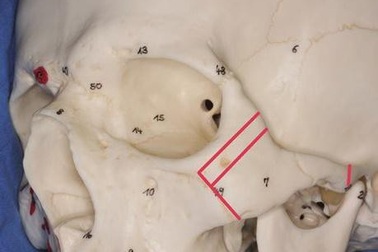 Thực hư về hạ gò má giúp trẻ ra chục tuổi