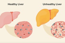 Cách đảo ngược bệnh gan nhiễm mỡ bạn cần biết