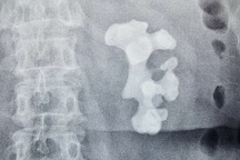 Sợ phẫu thuật, bệnh nhân bị “tảng” sỏi san hô lấp đầy thận